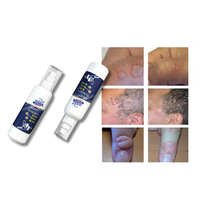 REMOVEDOR DE VERRUGAS WART REMOVER